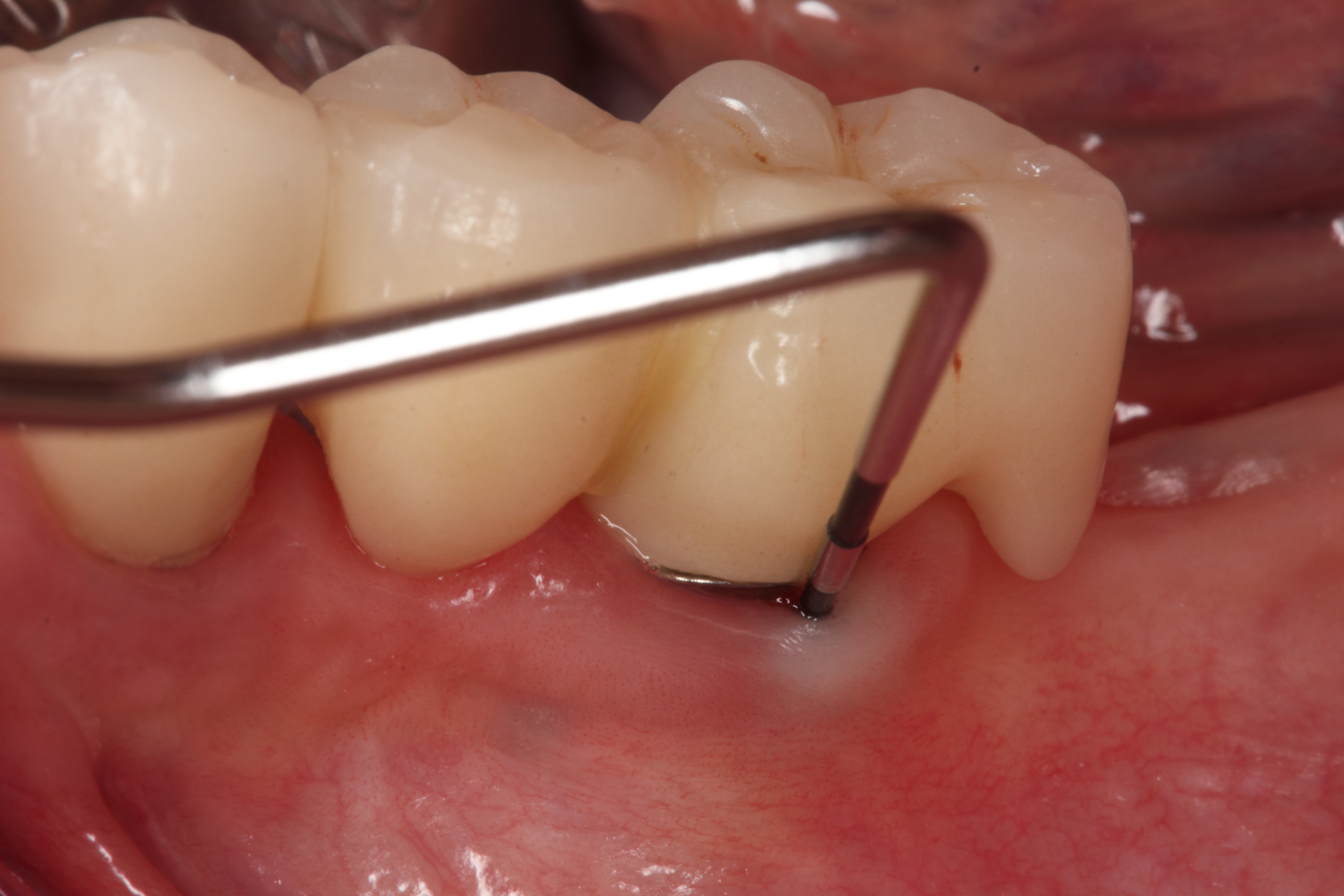 削らない最先端の虫歯 歯周病治療カリエスプロ カリソルブ療法 ドックベストセメント ぺリオプロ ペリソルブ療法